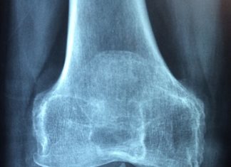 Młodzieńcze idiopatyczne zapalenie stawów